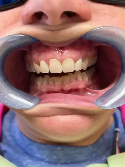 A close up of a woman 's smile with white teeth.