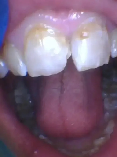 A close up of a woman 's mouth with white teeth.