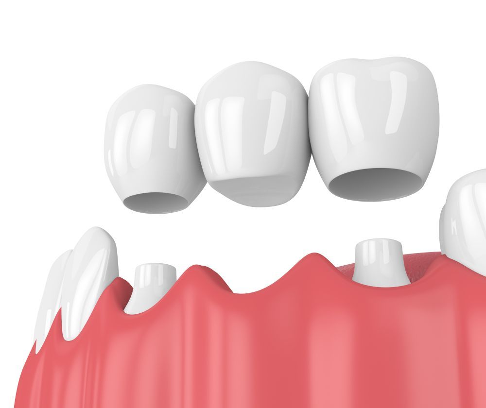 A 3d rendering of a dental bridge on a person 's teeth.