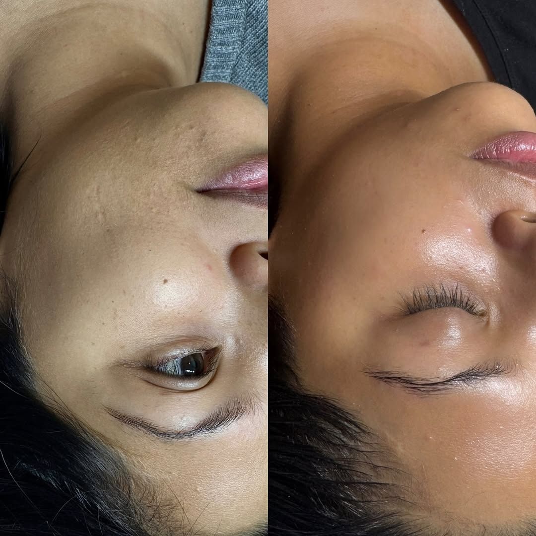 Viene mostrato il volto di una donna prima e dopo un trattamento viso.