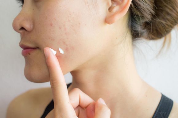 Applying Acne Cream on Face — Hillsborough, NJ — The Dermatology Center