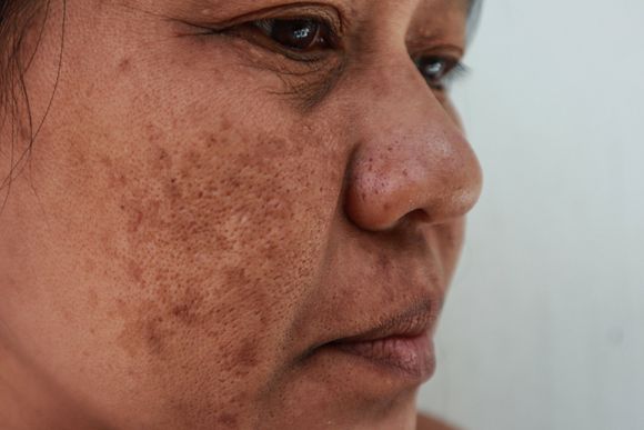 Melasma on Face — Hillsborough, NJ — The Dermatology Center