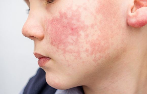 Skin Allergies on Face — Hillsborough, NJ — The Dermatology Center