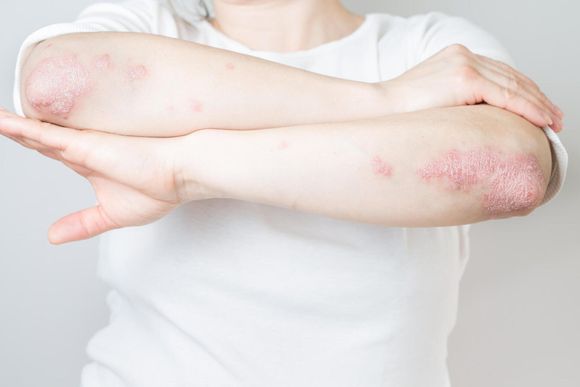 Acute Psoriasis on Elbow — Hillsborough, NJ — The Dermatology Center