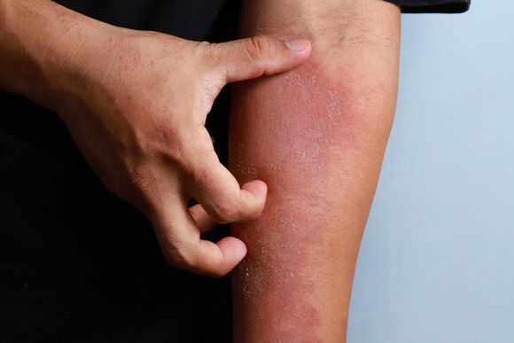 Eczema on Legs — Hillsborough, NJ — The Dermatology Center