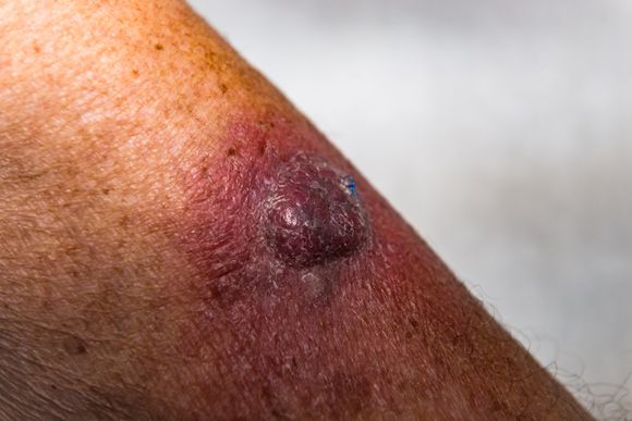 Invasive Squamous Cell Carcinoma on Left Arm — Hillsborough, NJ — The Dermatology Center