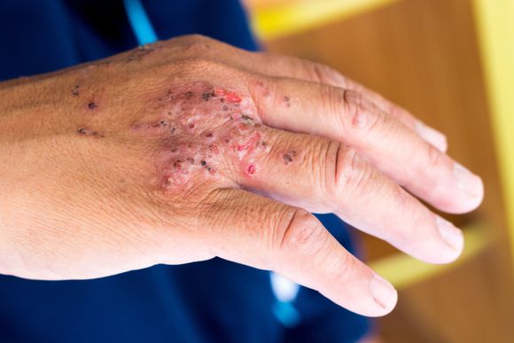 Skin Infection on Hand — Hillsborough, NJ — The Dermatology Center