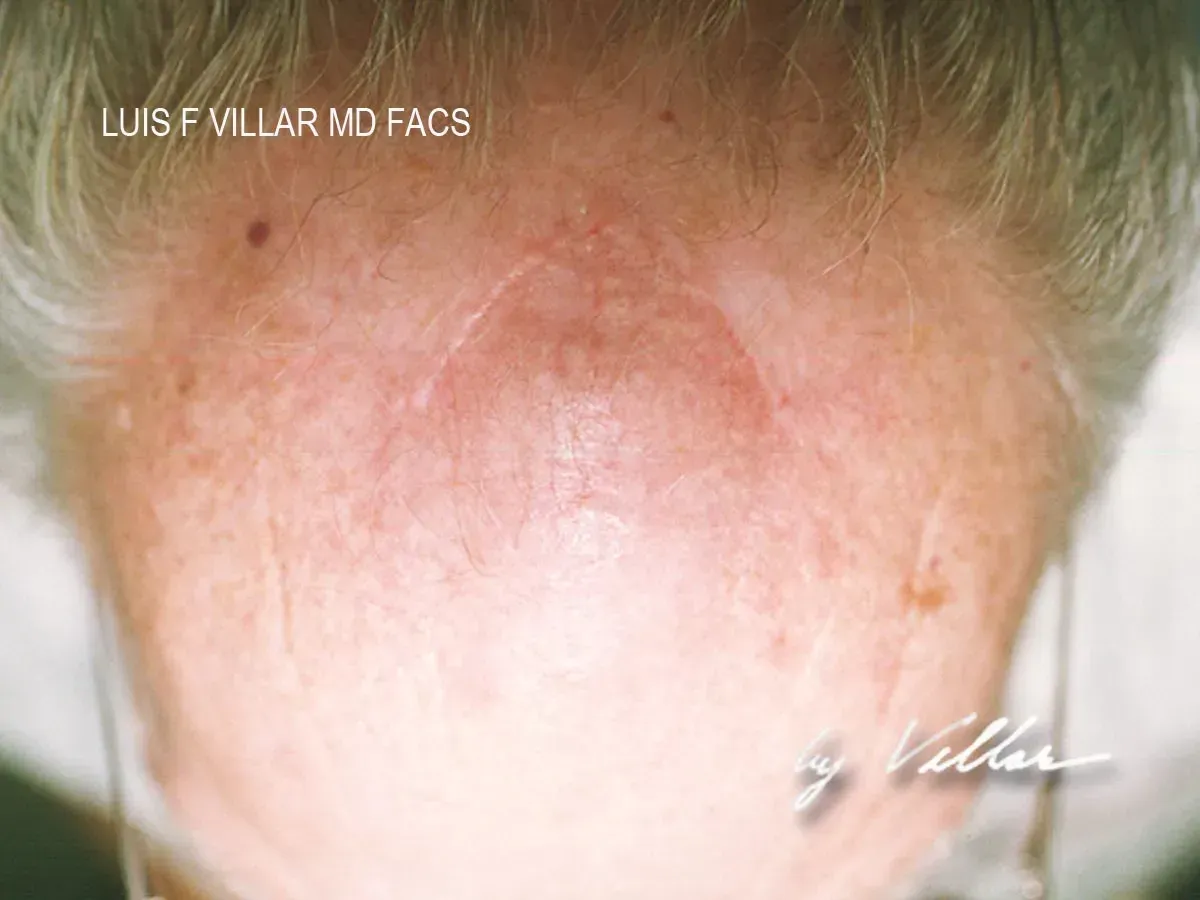 mohs procedure
