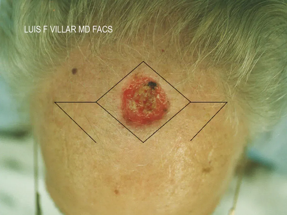 mohs procedure
