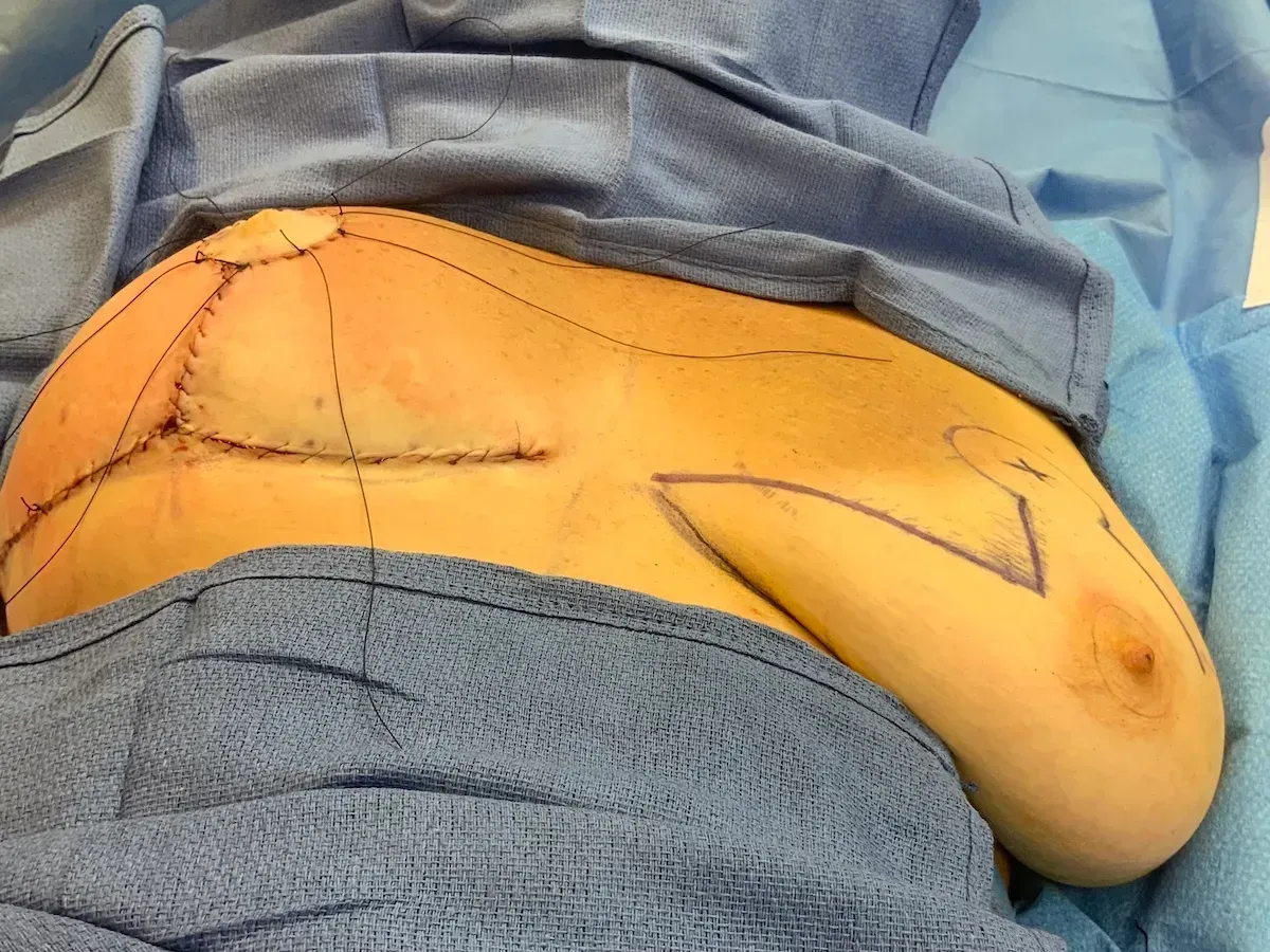 Breast Surgery