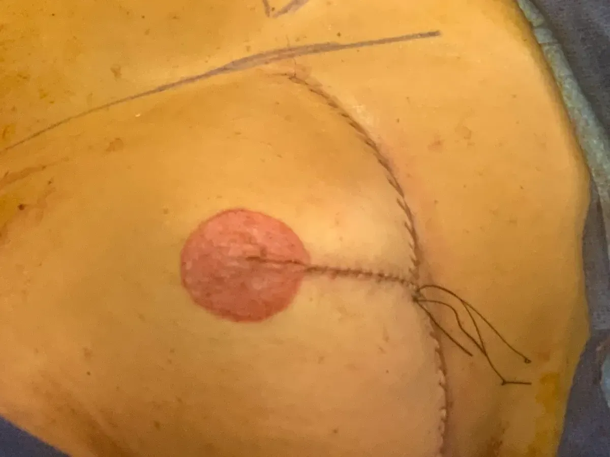 Breast Surgery
