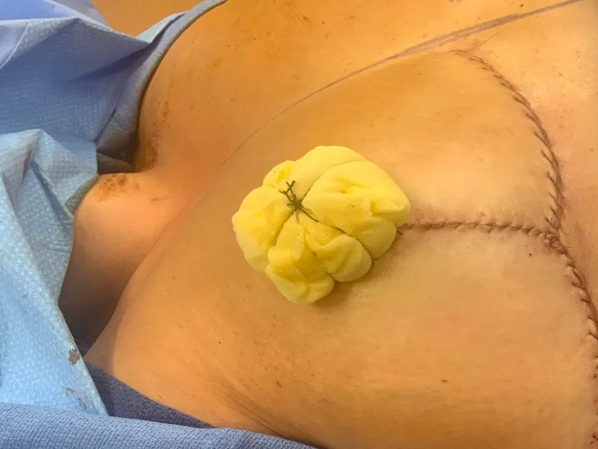 Breast Surgery