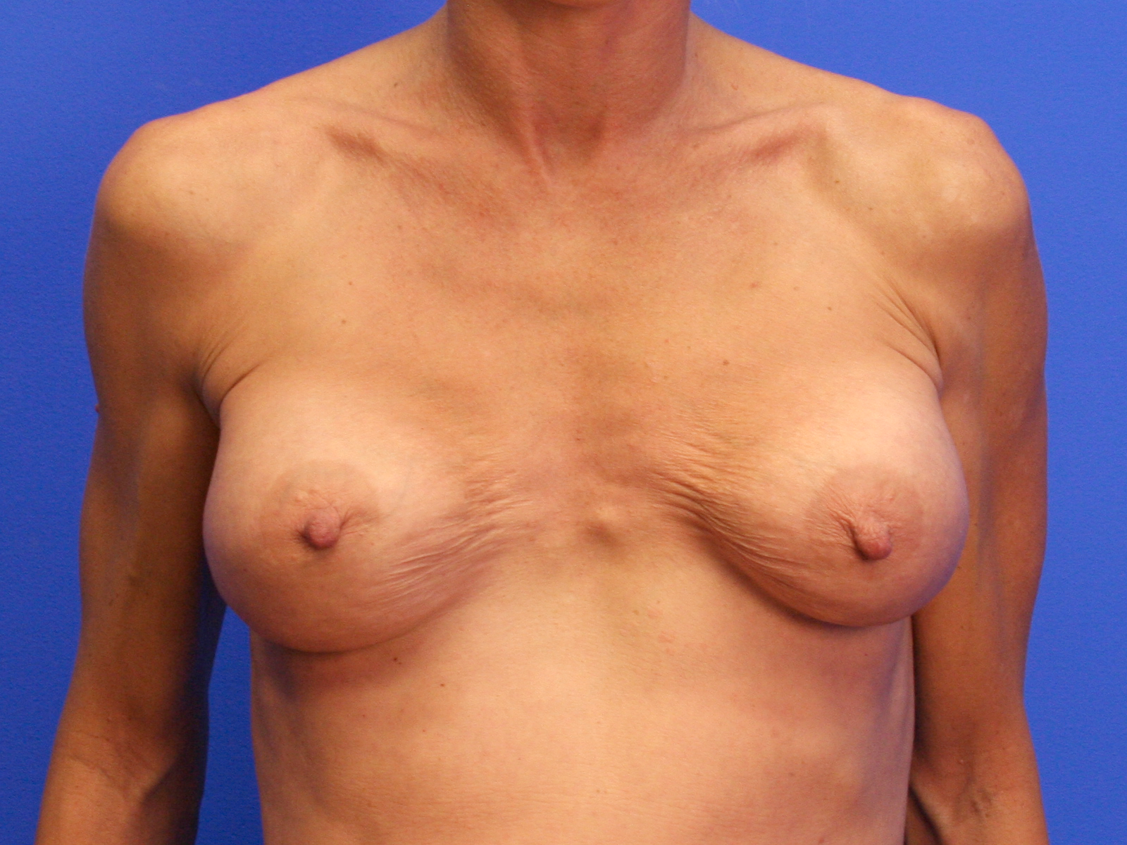 Breast Surgery