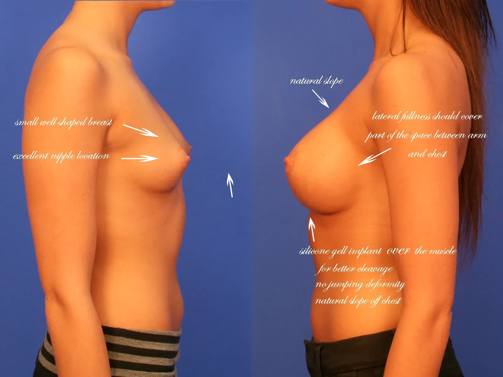 Breast Surgery