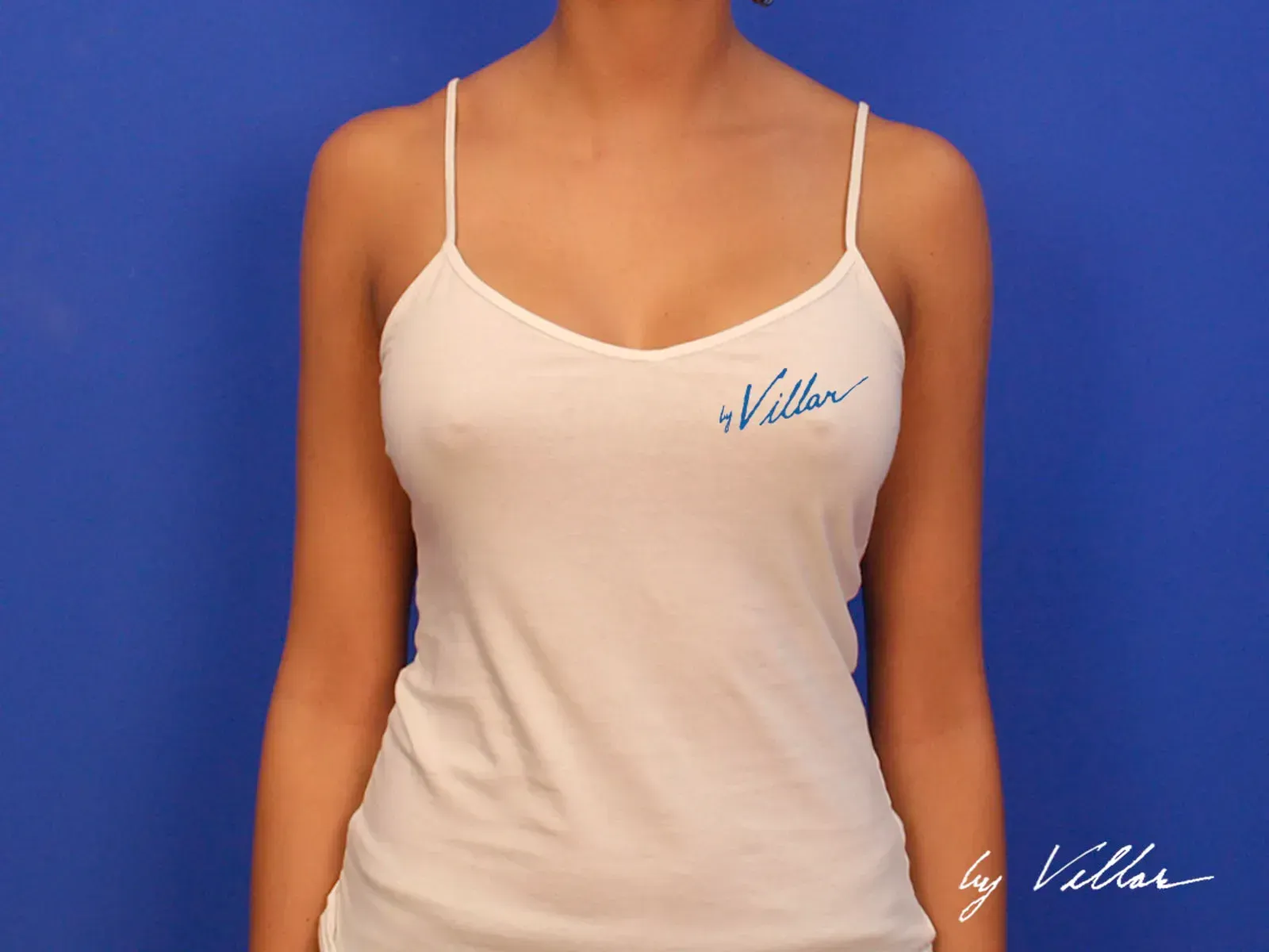 Breast Surgery