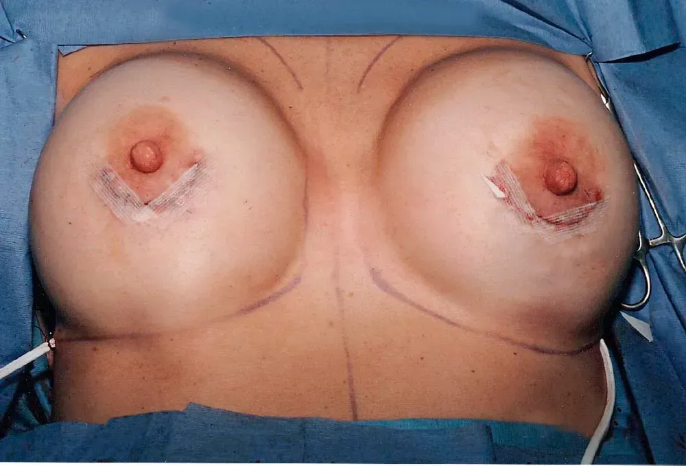 Breast Surgery