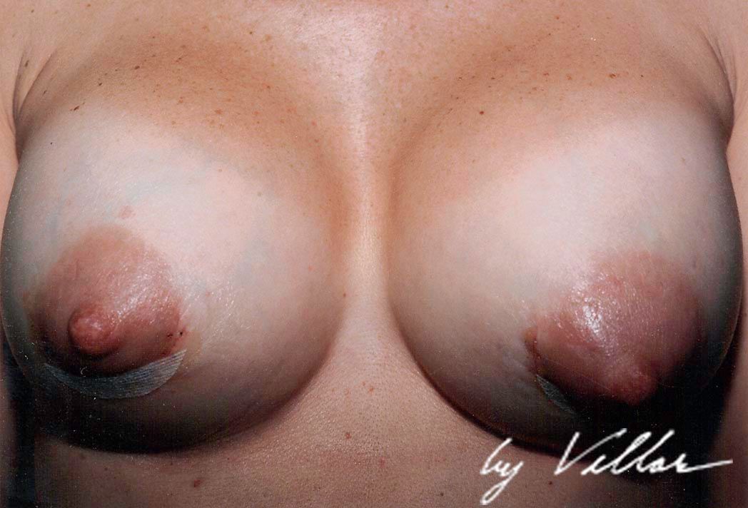 Breast Surgery