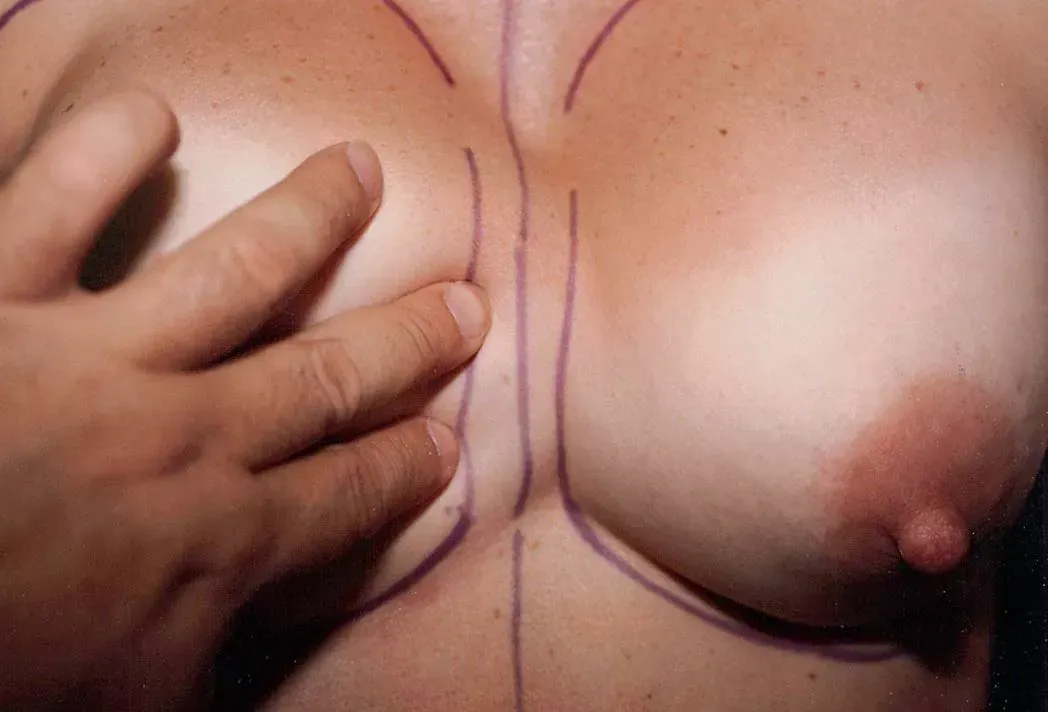 Breast Surgery