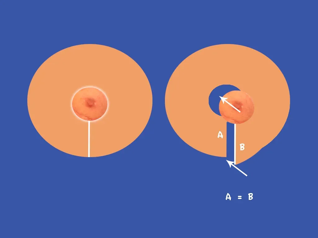 Breast Surgery