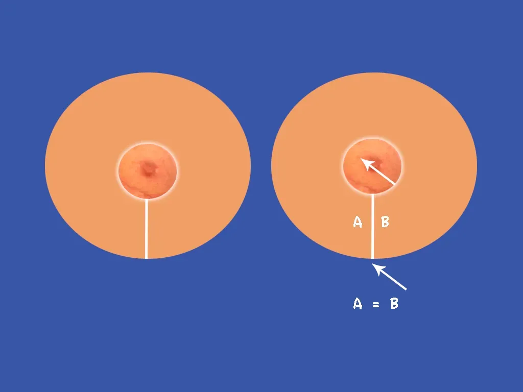 Breast Surgery