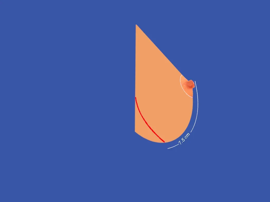 Breast Surgery