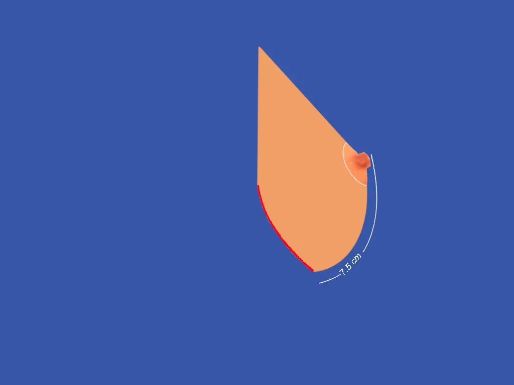 Breast Surgery