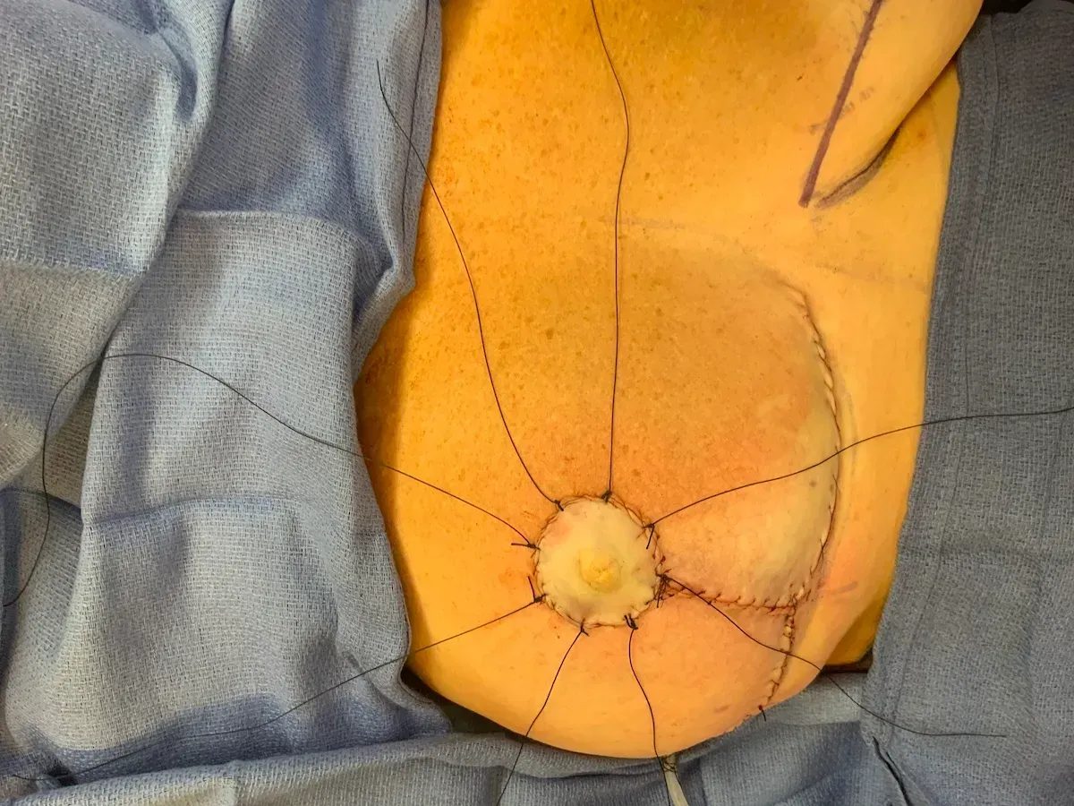 Breast Surgery