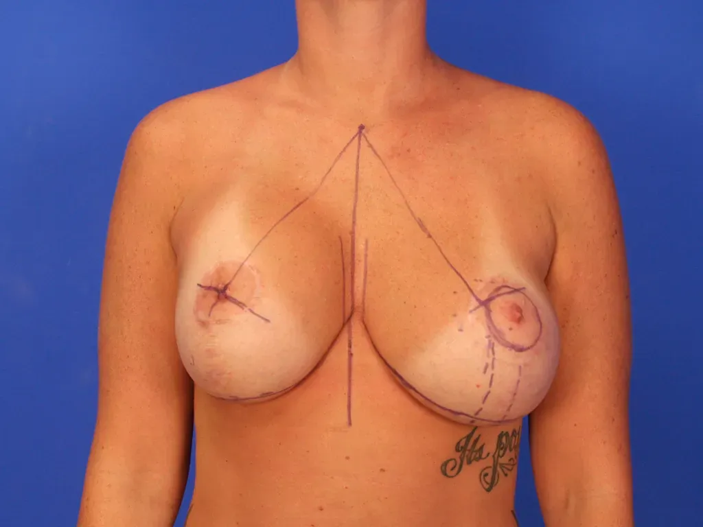 Breast Surgery
