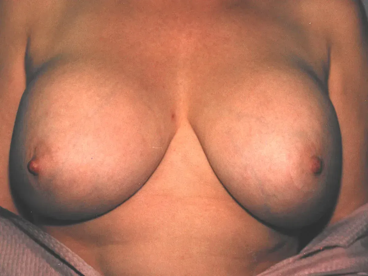 Breast Surgery