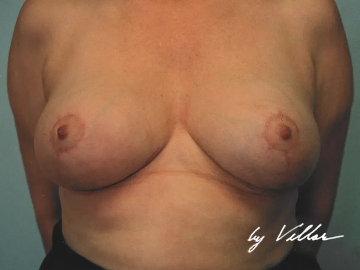 Breast Surgery
