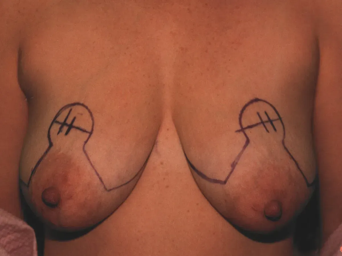 Breast Surgery