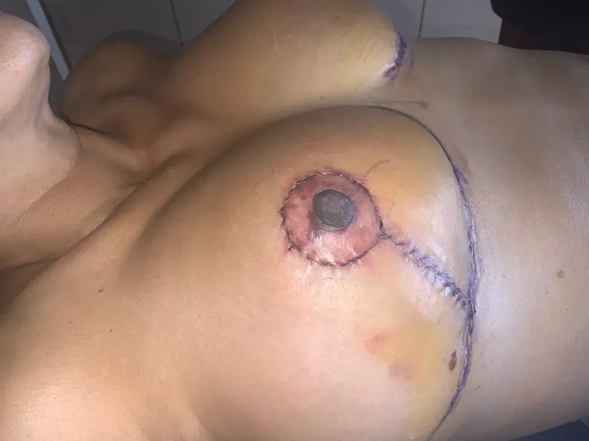 Breast Surgery