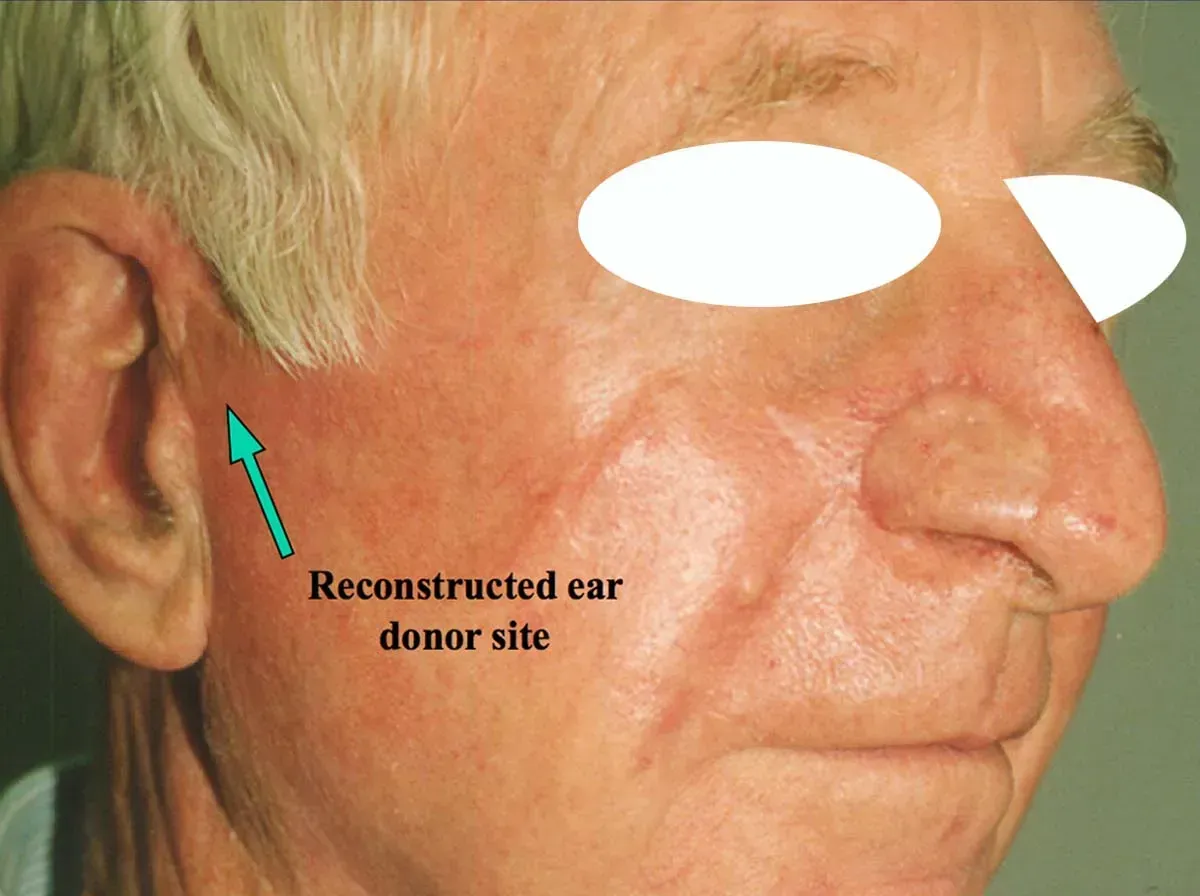 mohs procedure