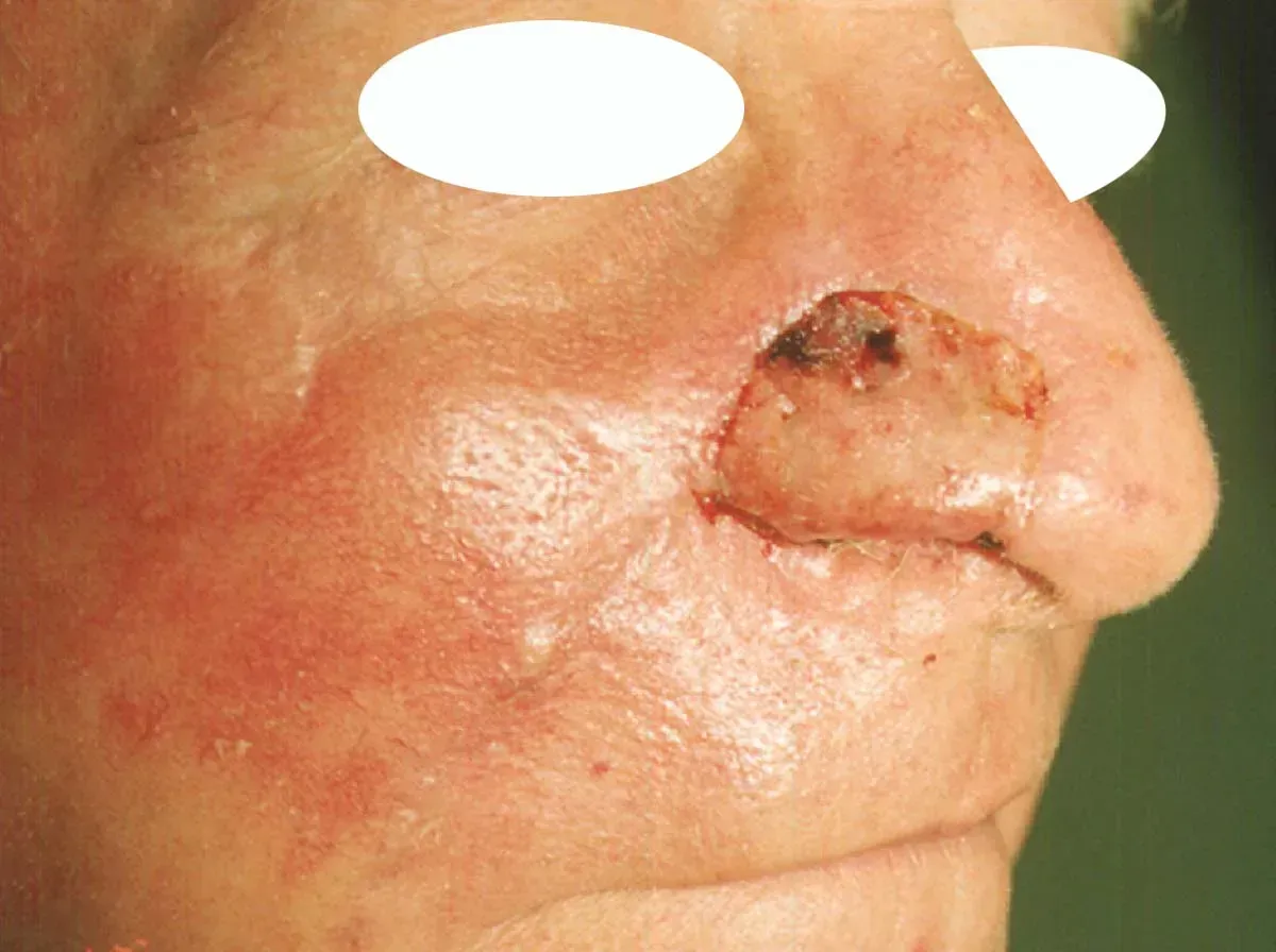 mohs procedure