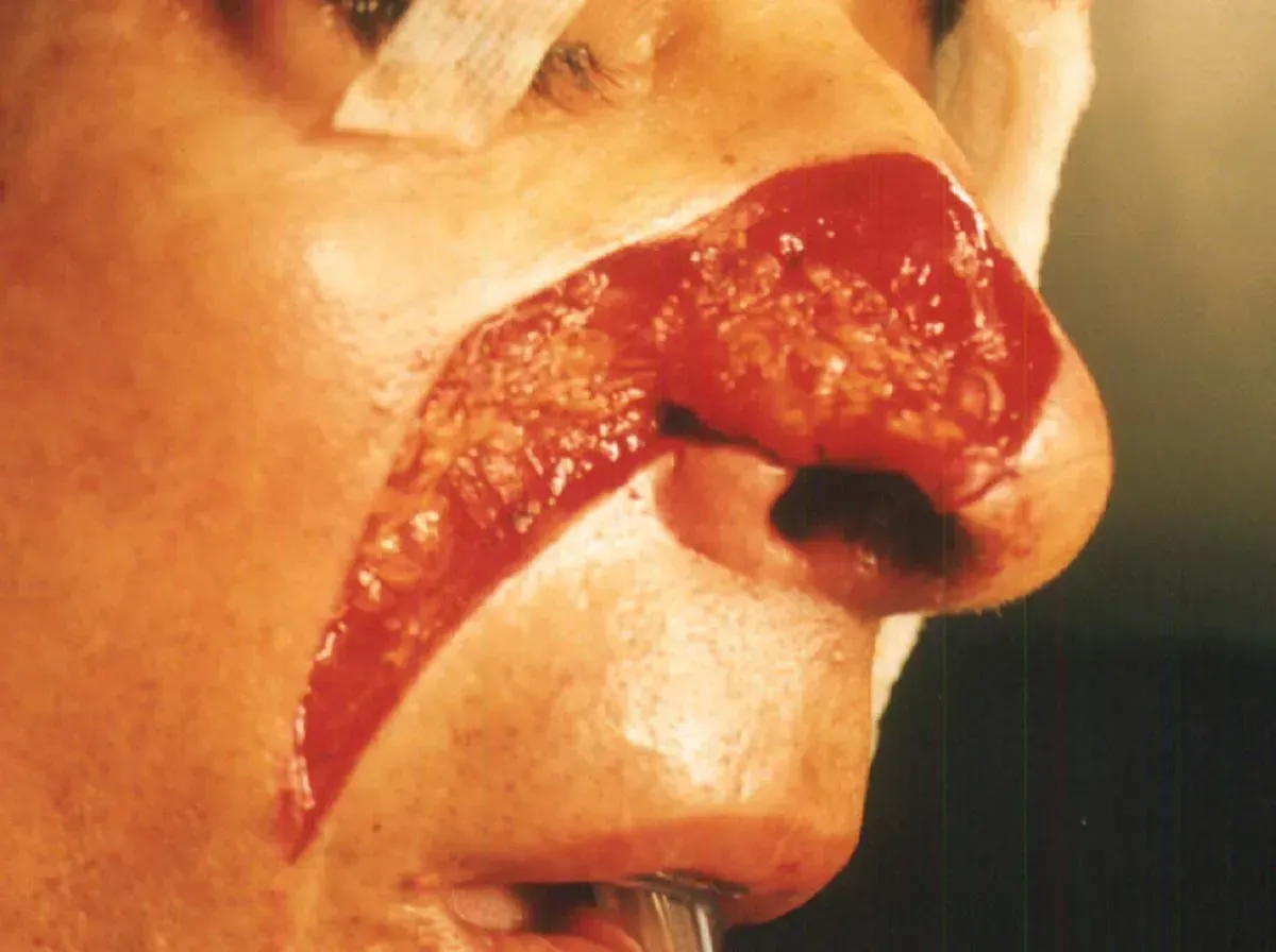mohs procedure