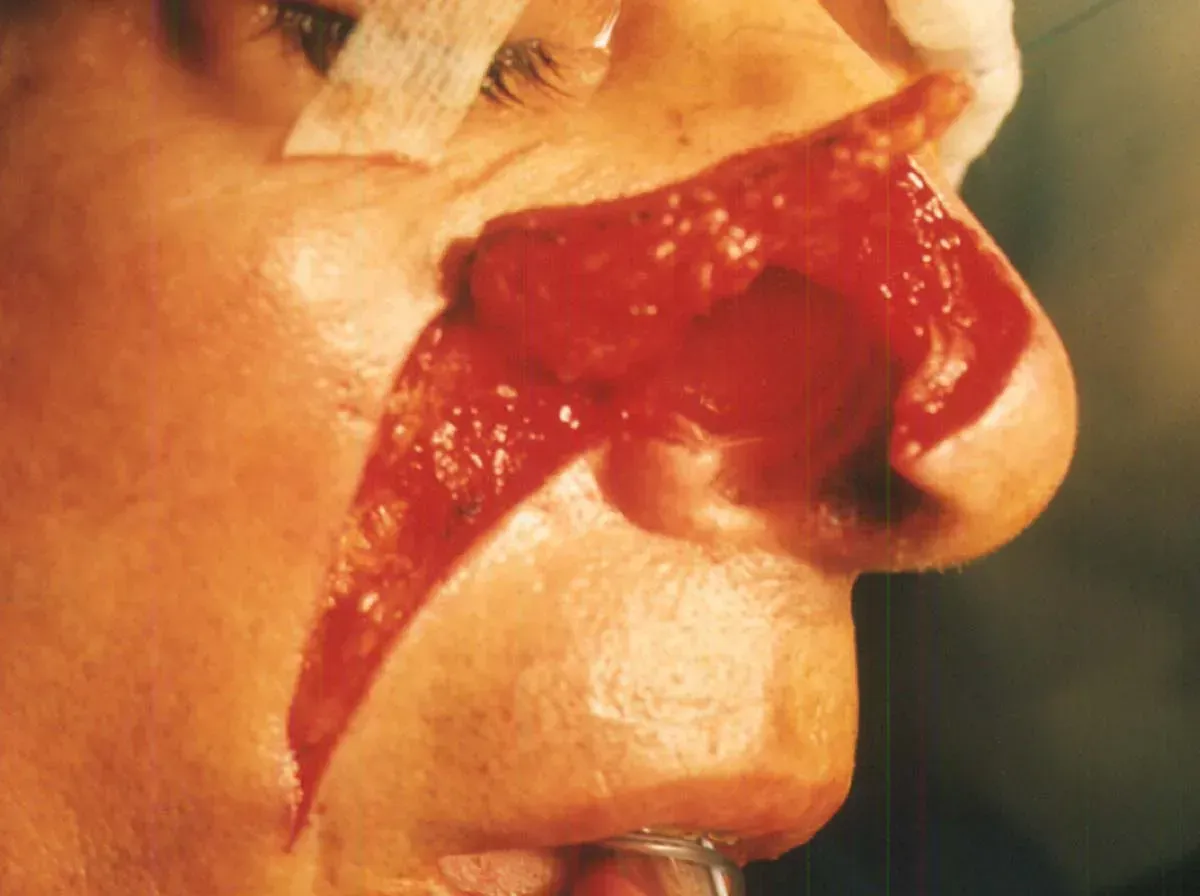 mohs procedure