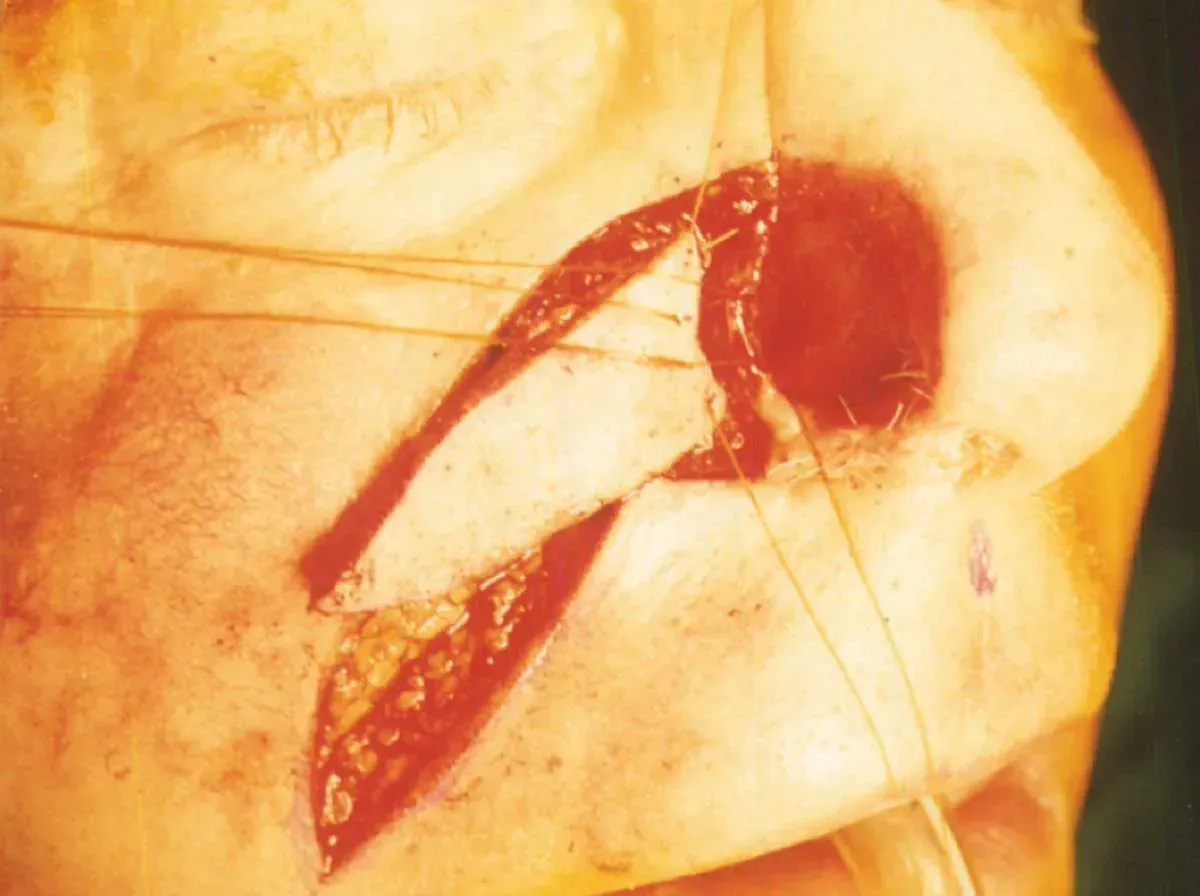 mohs procedure