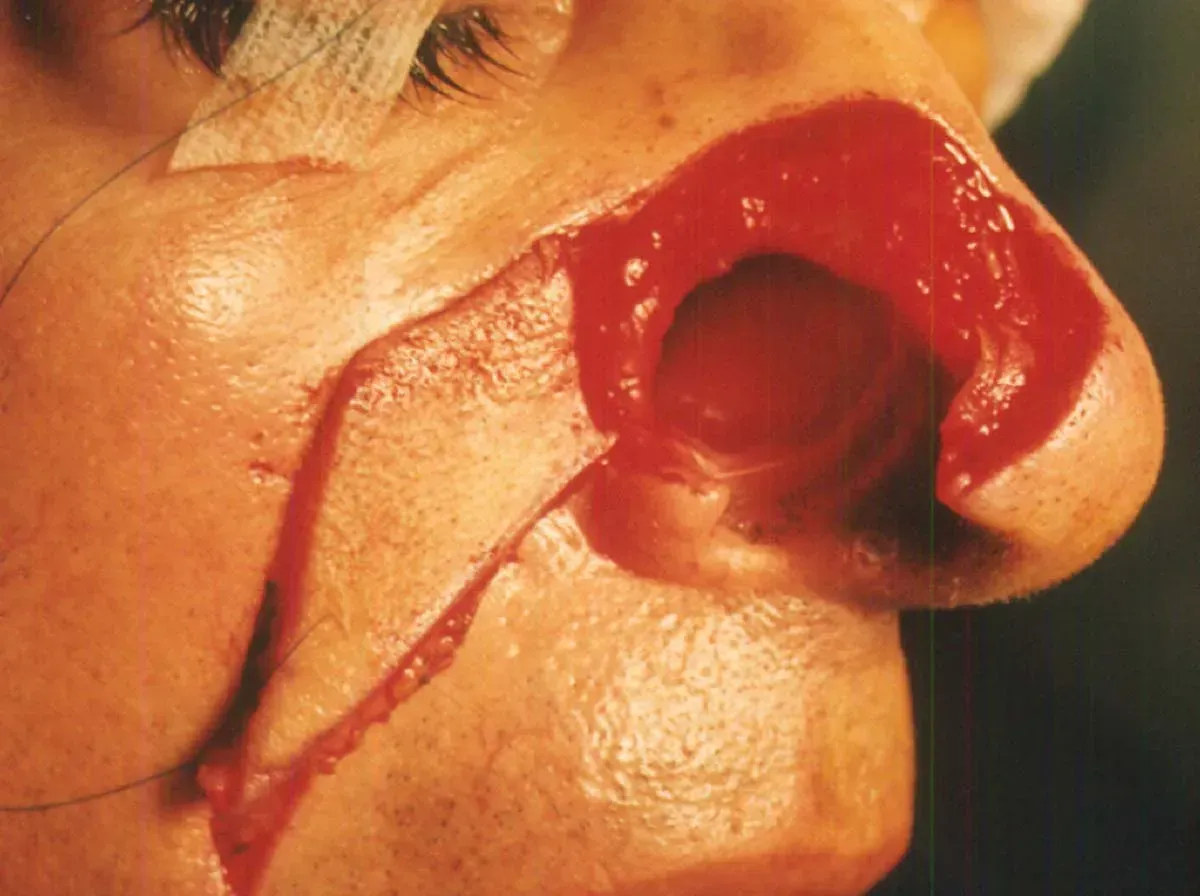 mohs procedure