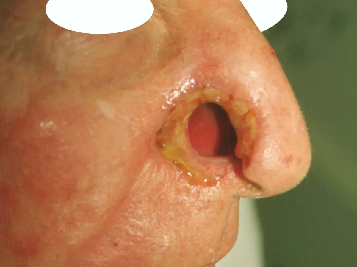 mohs procedure