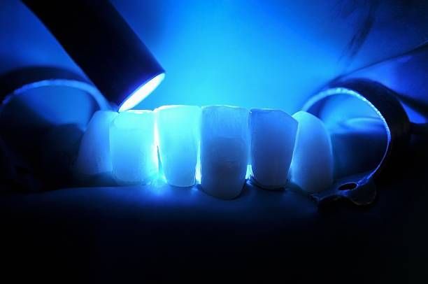 Dental Fillings — Edina, MN — Interlachen Dental Associate