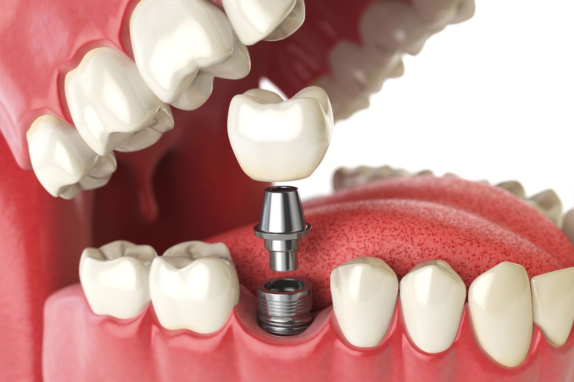 3D Illustration Of Tooth Implant — Edina, MN — Interlachen Dental Associates