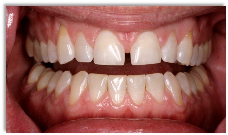Before Invisalign Treatment — Edina, MN — Interlachen Dental Associates	