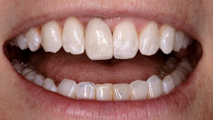 After Dental Implant Crown — Edina, MN — Interlachen Dental Associates	