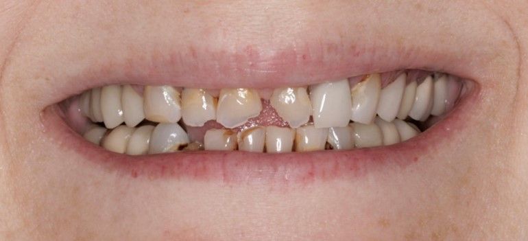 Before Full Mouth Rehabilitation — Edina, MN — Interlachen Dental Associates	