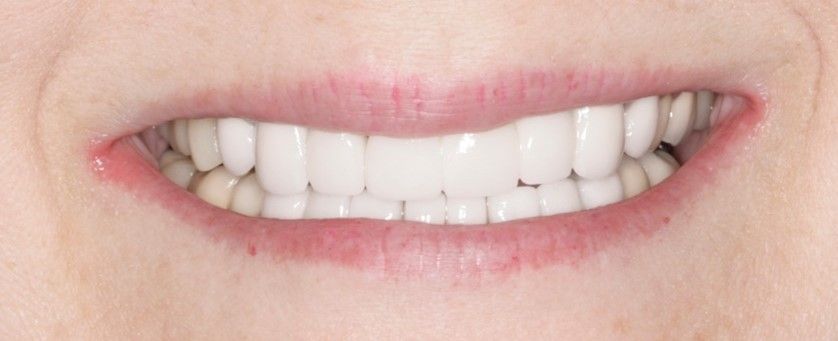 After Full Mouth Rehabilitation — Edina, MN — Interlachen Dental Associates	