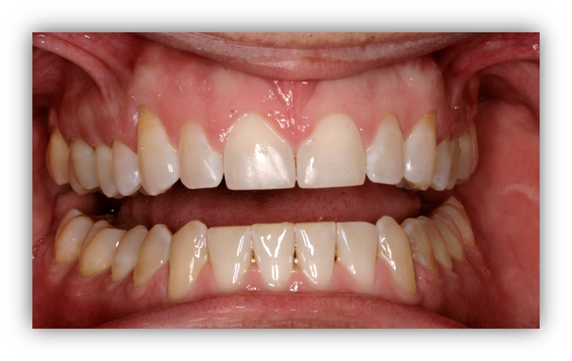 After Invisalign Treatment — Edina, MN — Interlachen Dental Associates	