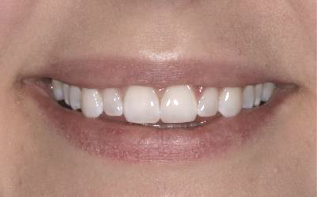 Before Composite Veneers — Edina, MN — Interlachen Dental Associates	