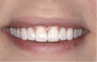 After Composite Veneers — Edina, MN — Interlachen Dental Associates	