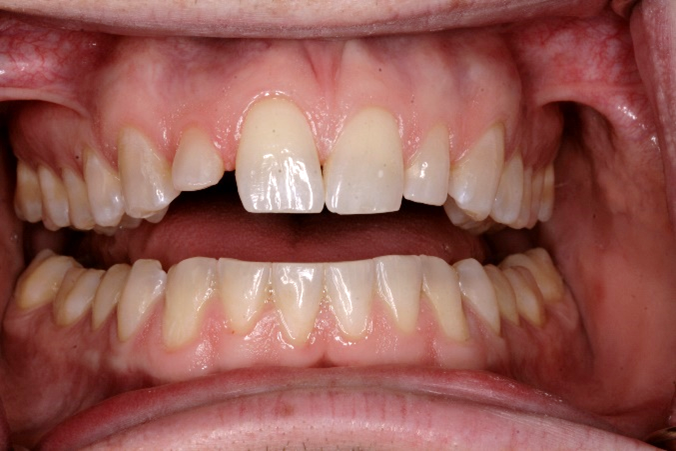 Before Invisalign Treatment And Porcelain Crowns — Edina, MN — Interlachen Dental Associates	