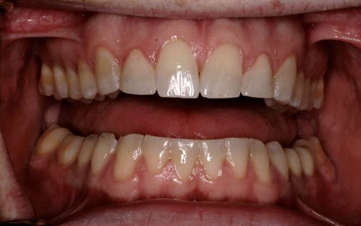 After Invisalign Treatment And Porcelain Crowns — Edina, MN — Interlachen Dental Associates	